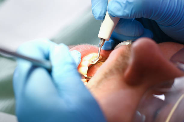 Best Emergency Dental Care for Broken or Chipped Teeth in Miami Beach, FL